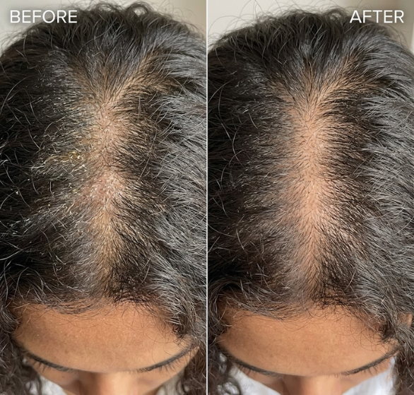 scalp peel.png